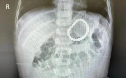 2歲幼童誤吞28顆磁力珠 結(jié)果揭露實(shí)在是讓人擔(dān)心不已