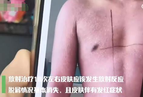 23歲小伙起紅疹被誤診6年查出癌癥 到底是什么情況?