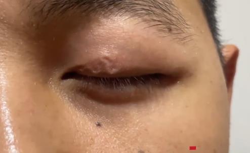 男子左眼皮異常抖動(dòng)有蟲(chóng)游走 背后真相曝光太驚悚了