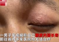 男子左眼皮異常抖動有蟲游走 背后真相曝光太驚悚了