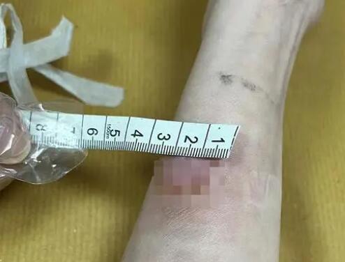 女子稱卷發(fā)棒爆炸致手臂二度燙傷 到底是什么情況?