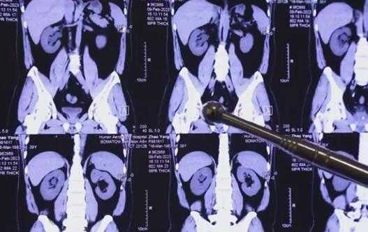 程序員20年喝近2噸可樂(lè)屢患結(jié)石 原因竟是這樣實(shí)在是太意外了