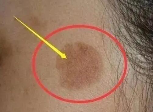 25歲女生長(zhǎng)期熬夜長(zhǎng)出老年斑 真相曝光簡(jiǎn)直太驚人了