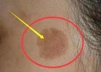 25歲女生長期熬夜長出老年斑 真相曝光簡直太驚人了