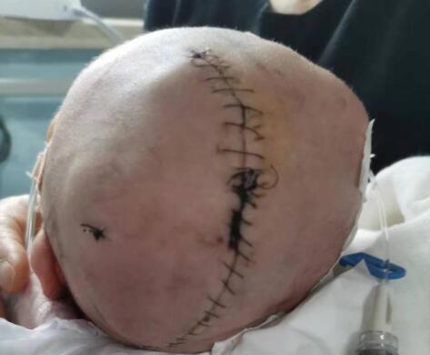 嬰兒出生后顱骨骨折 醫(yī)院回應 真相曝光簡直太驚人了