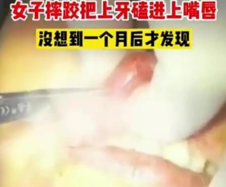 女子摔跤上牙磕進(jìn)嘴唇1月后才發(fā)現(xiàn) 具體事件經(jīng)過(guò)是什么?