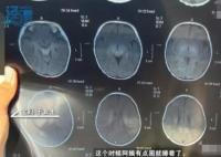月嫂拍嗝時打盹致嬰兒頭頂骨骨折 背后原因簡直驚呆了眾人