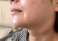 少女連續(xù)數(shù)日高燒不退確診接吻病 什么是接吻病?