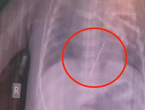 女嬰心臟扎進一根4厘米繡花針 結果真的令人大吃一驚