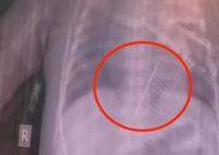 女嬰心臟扎進(jìn)一根4厘米繡花針 結(jié)果真的令人大吃一驚