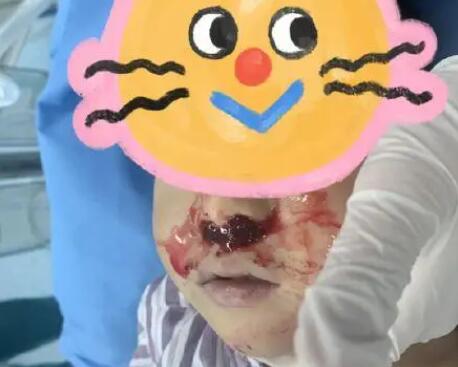 奶奶向3歲男童鼻腔塞頭發(fā)止血 真相曝光簡直太驚人了