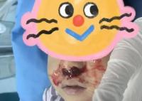 奶奶向3歲男童鼻腔塞頭發(fā)止血 真相曝光簡(jiǎn)直太驚人了