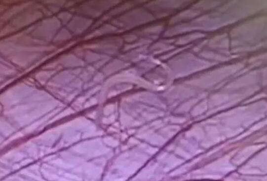 女孩外地求醫(yī) 切開闌尾有蟲子游出 這條游動“小蟲”到底是什么呢?