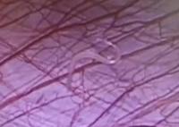 女孩外地求醫(yī) 切開闌尾有蟲子游出 這條游動(dòng)“小蟲”到底是什么呢?