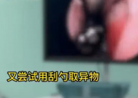 男孩鼻子惡臭兩年 取出顆生銹螺絲 究竟是怎么回事？