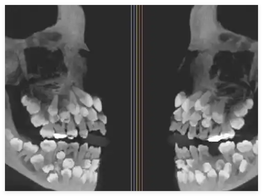 巴西11歲女孩拔牙時(shí)發(fā)現(xiàn)81顆牙齒 始料未及真相簡直太意外了