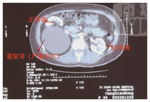 江西新余女子意外發(fā)現(xiàn)三個腎 簡直太意外了