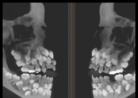 巴西11歲女孩拔牙時(shí)發(fā)現(xiàn)81顆牙齒 始料未及真相簡直太意外了