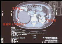 江西新余女子意外發(fā)現(xiàn)三個(gè)腎 簡(jiǎn)直太意外了